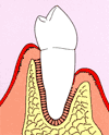 歯周病の歯と歯茎