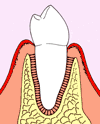 GTRによる歯周組織の再生
